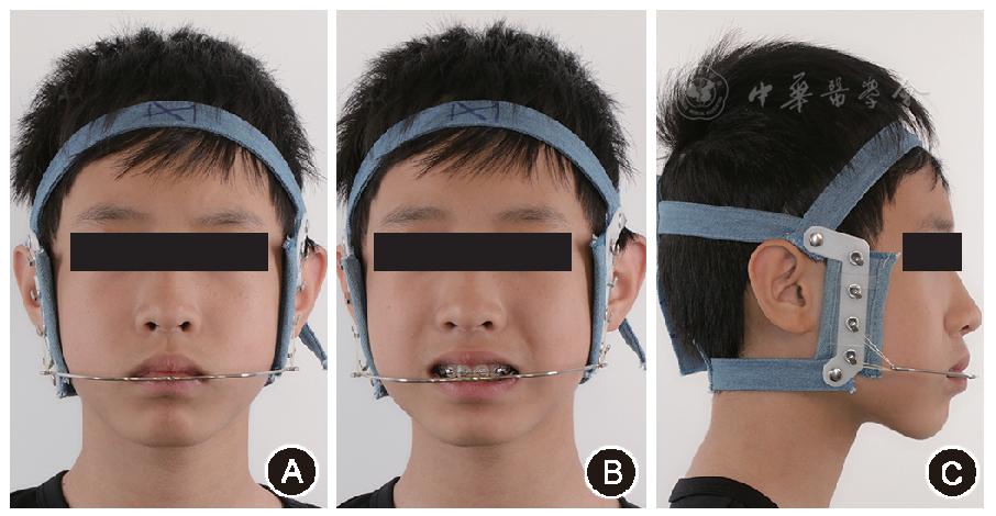 图4 骨性Ⅱ类错患者矫治9个月时(二期矫治)配戴头帽-口外弓的面像 a