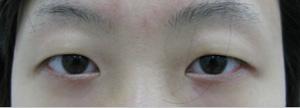 鱼泡眼mm做双眼皮手术效果图