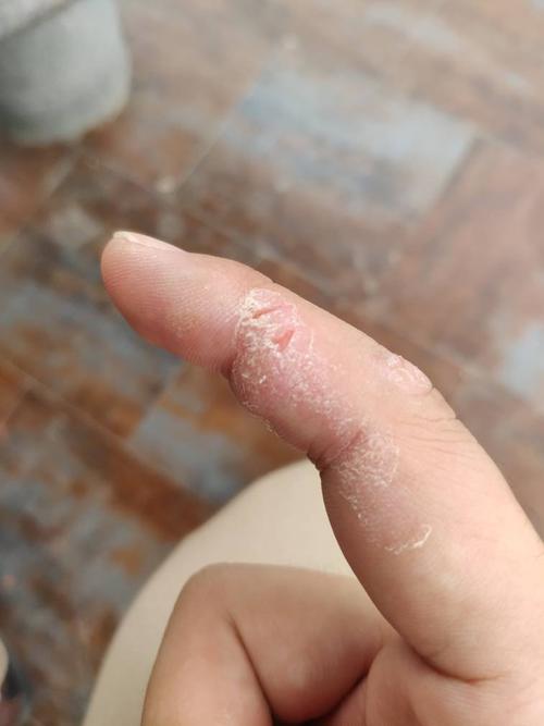 手上出了这样的癣,不知道是什么问题,懂医懂皮肤科的朋友给看看,谢谢