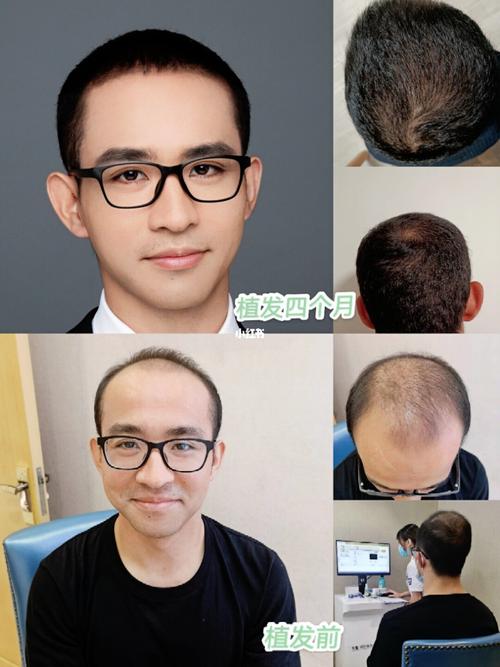 植发恢复期的10条攻略可以让你年轻20岁