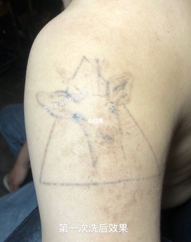 皮秒洗纹身第一次后效果对比,_纹身_皮秒_江汉路步行街自由行热门攻略