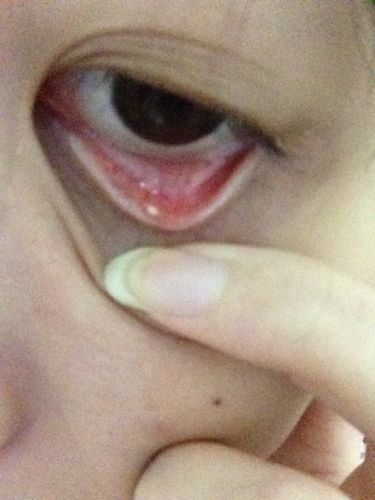 眼科求助,下眼皮里长了一个小白点,有图