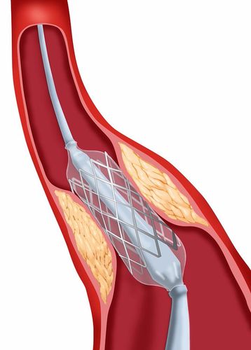 放了心脏支架,我还能运动吗?