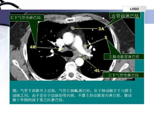 lgo ol 第7页 (共11页,当前第7页) 你可能喜欢 淋巴结肿大 纵隔淋巴结