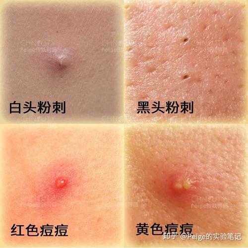 白色痘痘(闭口粉刺)