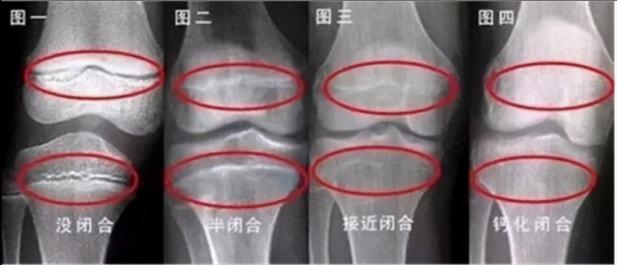 16岁男孩165cm骨骺线将要闭合医生做好3件事或能补救