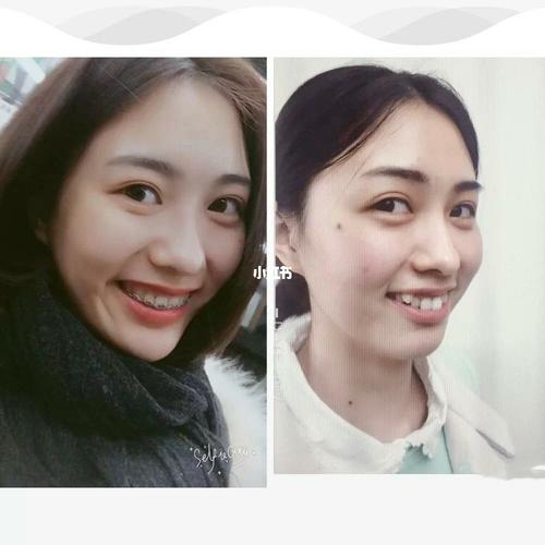 虎牙矫正286天,整牙效果对比_整牙_牙套_摄影_牙齿矫正_保持器_美妆