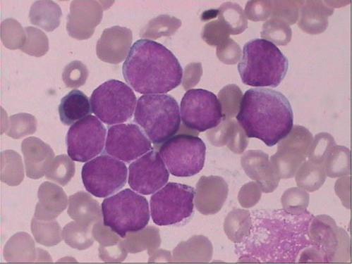 幼年型粒单核细胞白血病,儿童早期罕见骨髓增生异常综合征