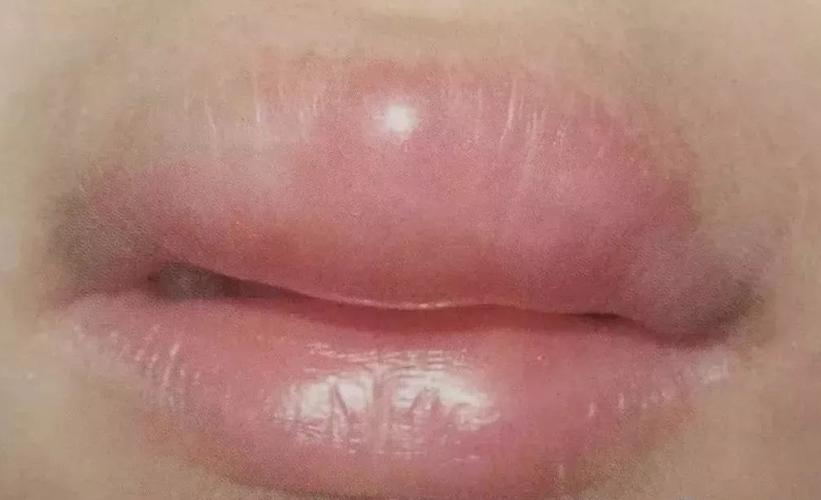 嘴唇突然出现水肿后,又迅速消失,并非是简单的过敏!