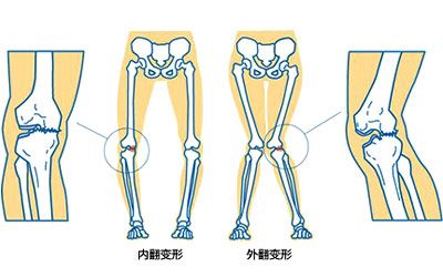 得了佝偻病会有什么表现