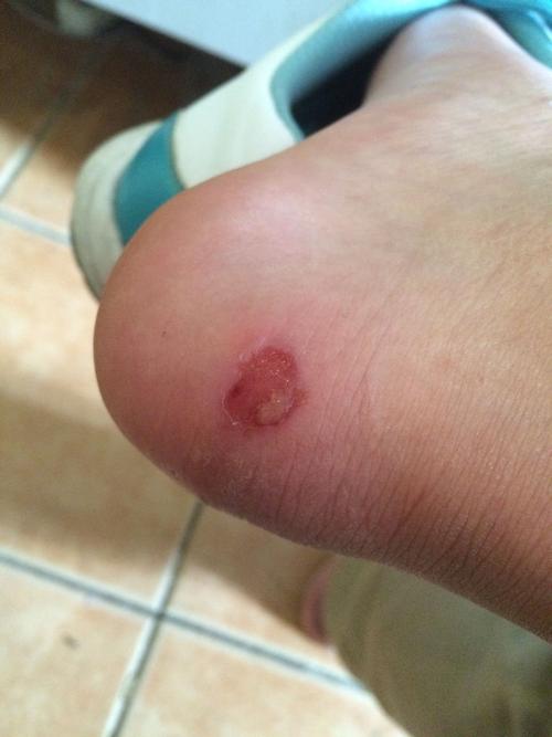 脚后跟磨破了怎样好的快 现在在上班 还必须穿运动鞋