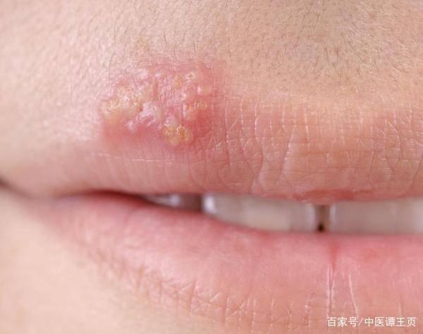 嘴唇上长泡该怎么消除?|疱疹|口腔溃疡|上火|水泡