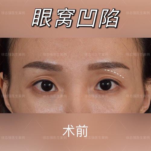 【案例分享】脂肪胶填充丰眼窝术后3个月