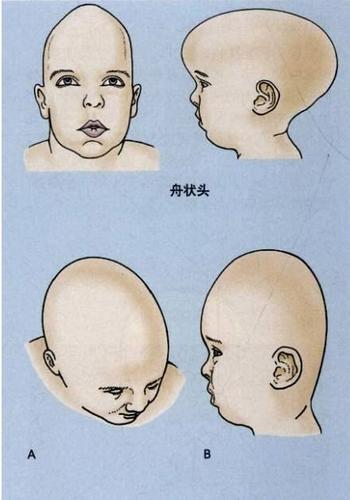 孩子头型奇怪,注意颅缝早闭