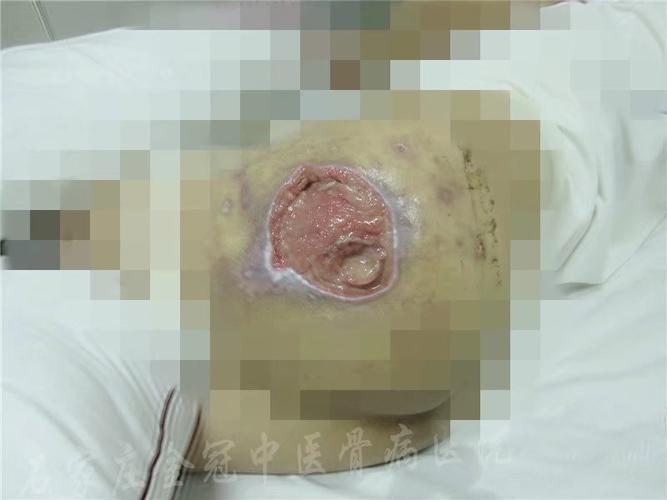 贵州省遵义市姚先生左侧臀部褥疮金冠治疗篇