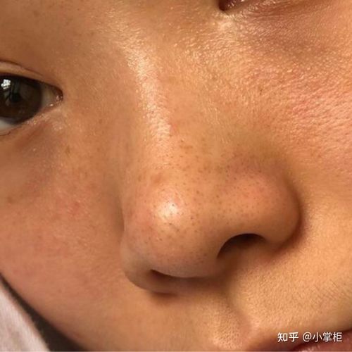 女生脸上毛孔粗大有黑头痘痘还很红怎么办