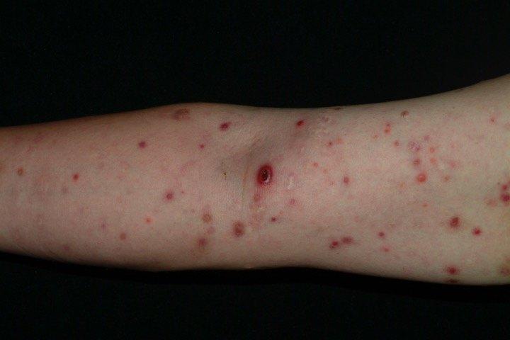 淋巴瘤样丘疹病是什么?