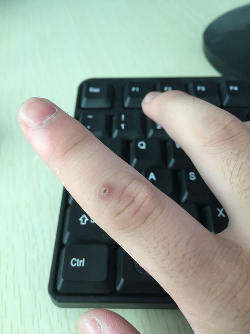 手上这个鼓起来的包 我扣烂了又长住是个肉包 这是什么东东 怎么解决