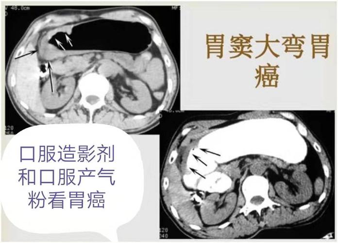 胃癌的显影.