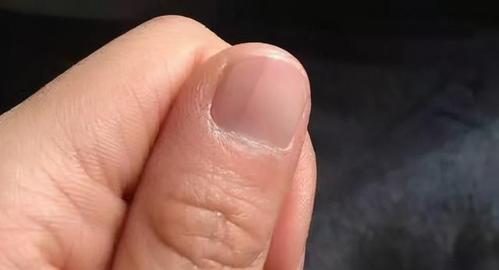 指甲上出现这些竖纹竟是大病预兆!