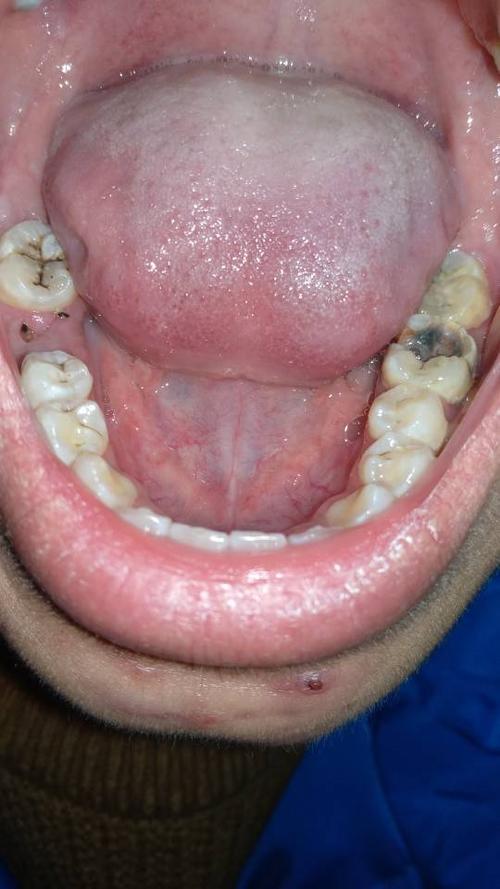 还有就是有蛀牙能不能当兵,第二张图是上面,第三张是下面牙齿.