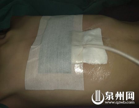 水升凹陷的胸部可以放下一个拳头