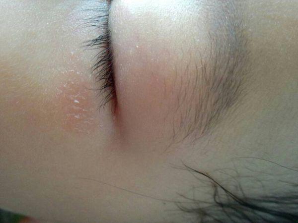 宝宝眼下面一块红,现起皮了,怎么办?