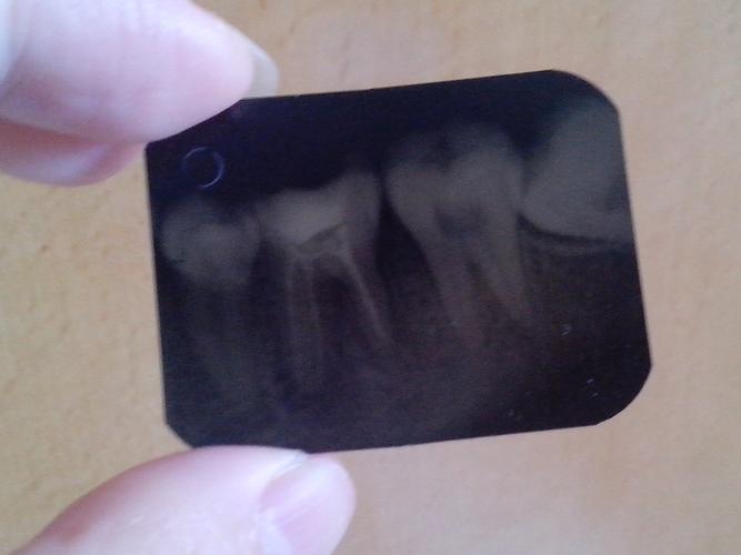 之前在诊所做完根管治疗后,拍了牙片,医生说充填过细而且有超充,很有