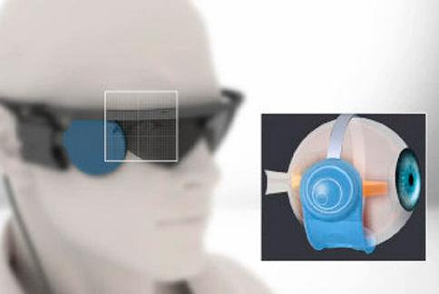 人工视网膜在美上市