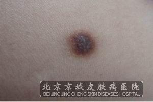 关于这个问题,下面我们就请北京京城皮菲し纤维瘤