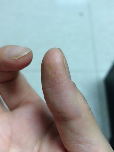 36岁女子手干裂医生苦劝这类食物多往冰箱放是身体必备