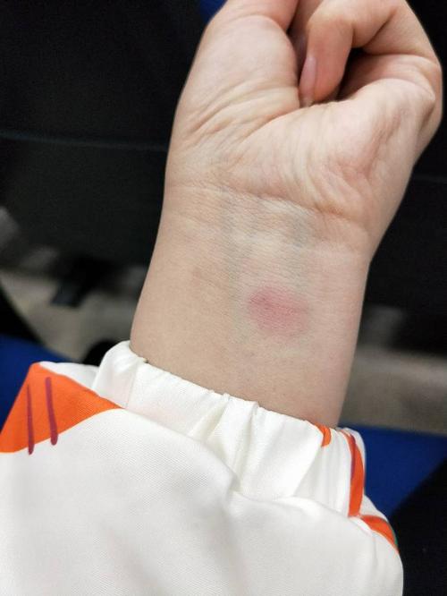 做完肺结核皮试第二天是这样的 不痛不痒 正常嘛