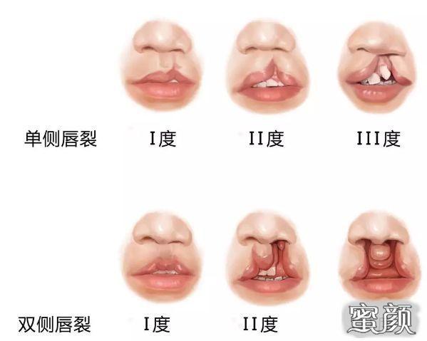 唇裂整形手术需要多少钱?