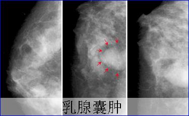 乳腺囊肿必须手术治疗吗?还有没有其他的办法?