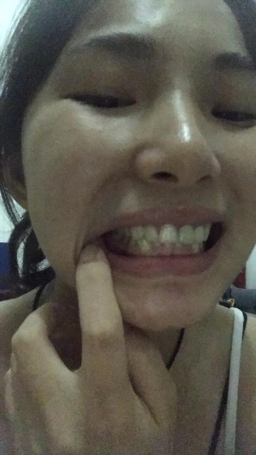 如果牙齿是比较前凸的,通过矫正可以收回去;而牙齿比较扁平的,矫正又