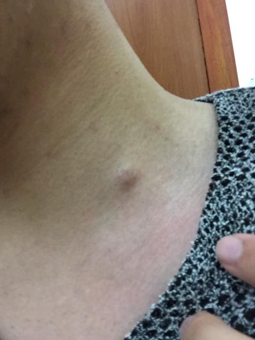 脖子里不知道什么时候多了个小疙瘩,可能有一年左右了