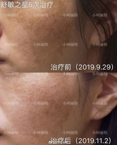 舒敏之星(射频)导入氨甲环酸来改善黄褐斑 ↓