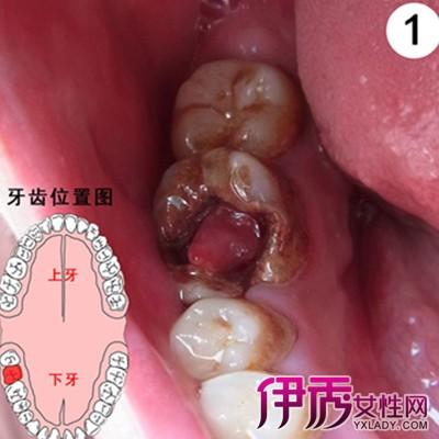 【图】盘点牙息肉有什么危害 8大治疗方法轻松牙息肉