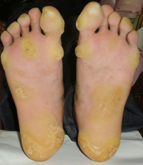 潮虫治脚垫效果奇好!