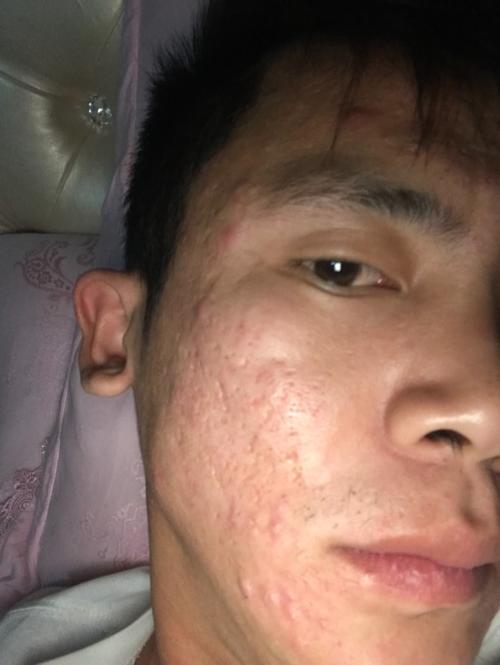 我脸上的坑坑洼洼痘疤是以前长痘用手挤留下来的怎么修复价格和有什么