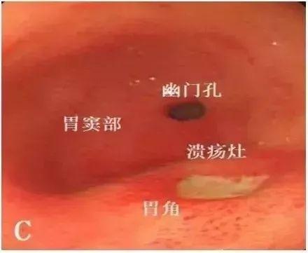 典型胃溃疡超声声像图,不输于做胃镜!| 临床实用
