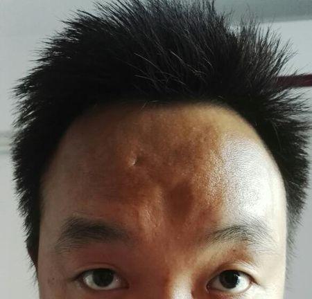我的额头最近两三年越来越凹陷是怎么回事?以前额头都