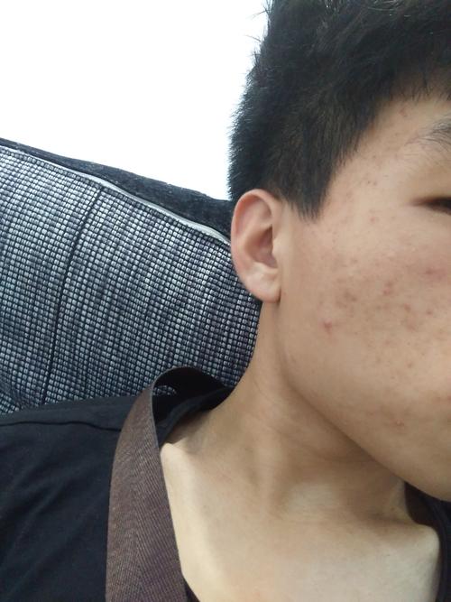 长了好多痘痘留下了痘疤怎么办呢求求帮帮我