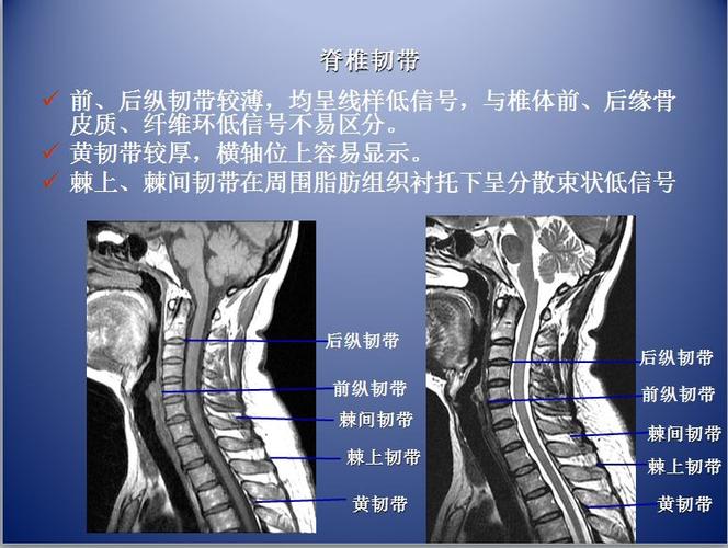 脊柱ct,mr断层解剖2