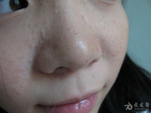 小女孩面部皮疹