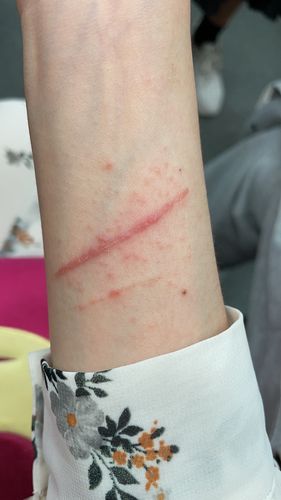 朋友被我家猫抓伤第九天后伤口周边起小疹子08