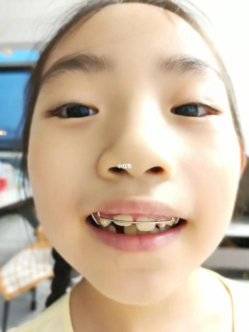 孩子开始扩弓矫正了_牙齿矫正_牙套_美妆_医美整形