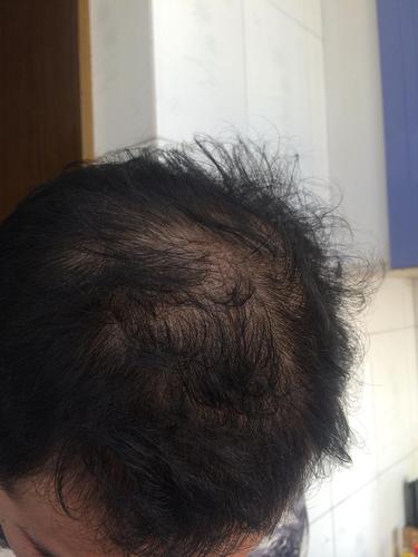 我是一枚男同胞.现在是脂溢性脱发,很严重!都快.