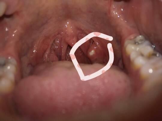 孕妇怀孕七个月喉咙长了白色的颗粒在肉里面,说话很疼