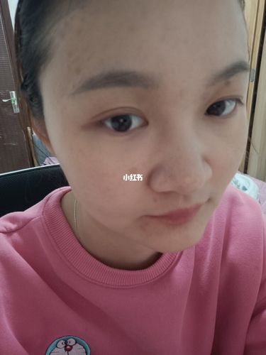 点痣二十天了_点痣_酱油_辣椒_美妆_医美整形